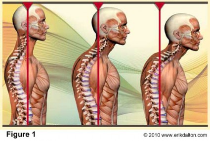 Forward Head Posture Denver Chiropractor_0