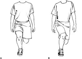 knee-valgus-on-lunge