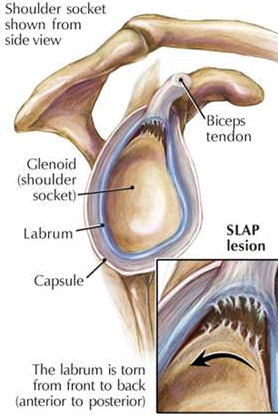 shoulder_slap_tear_drawing