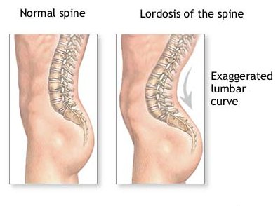 lordosis1