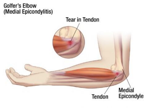 medial-epicondylitis